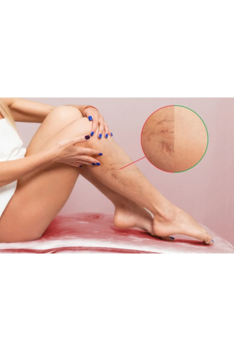 Varicose Vein Defense Cream 150 ml x 3 Bacaklar için Bakım Kremi