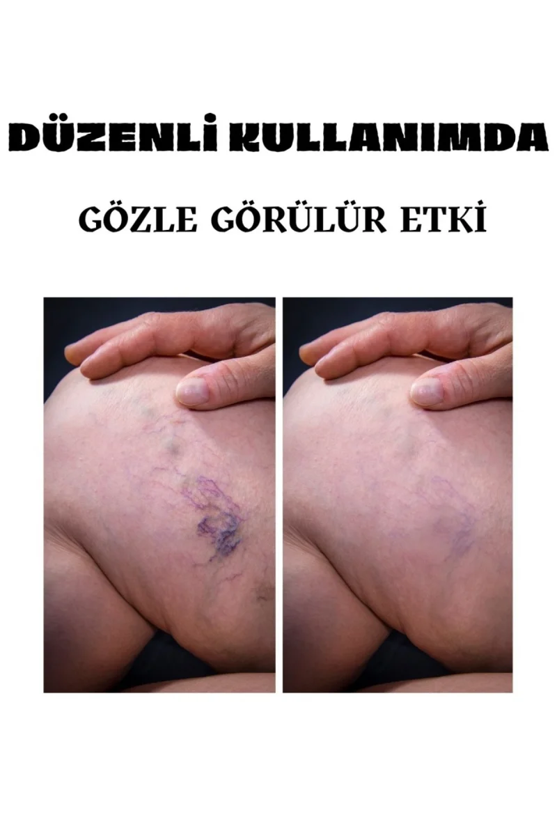 Varicose Veins Var.is Kremi 100 ML