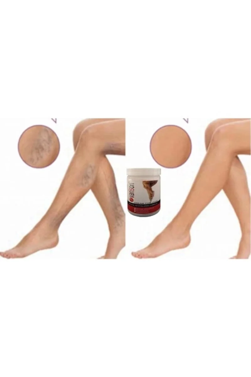 Varison Varicose Vein Defense Cream Diz Bacak Bakım Kremi 200ml+50ml Ayak